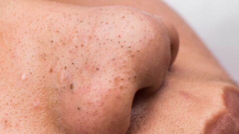 Lif Fillers and Blackhead Extraction: The Ultimate Skincare Guide Lif Fillers and Blackhead Extraction: The Ultimate Skincare Guide