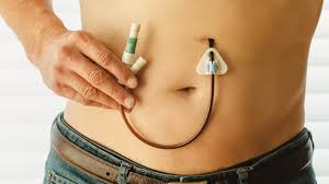 Peg Feed Training and Epilepsy Training: Essential Care Skills for Caregivers Peg Feed Training and Epilepsy Training: Essential Care Skills for Caregivers