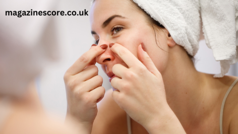 The Ultimate Guide to Popping Blackheads Risks, Best Practices, and Alternatives popping blackheads