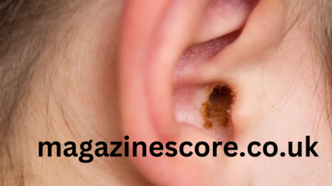 Ear Blackheads Causes, Prevention, and Effective Removal Methods ear blackheads