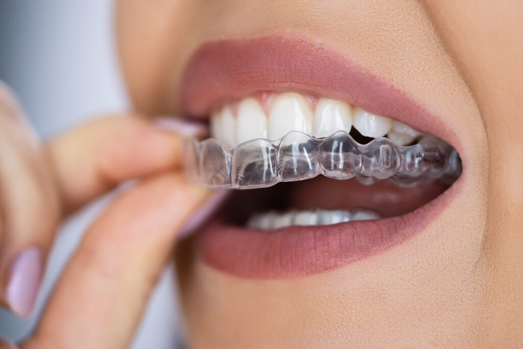 Transform Your Smile: Dental Clinics and Braces in Leicester You Can Trust Dental Clinics